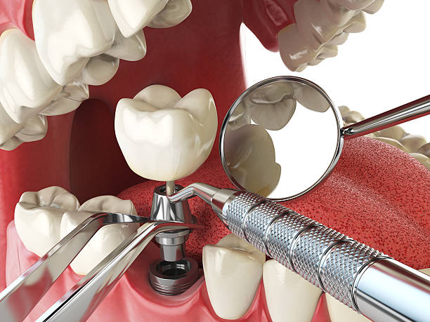Best Lost Filling or Crown Replacement in Leominster, MA